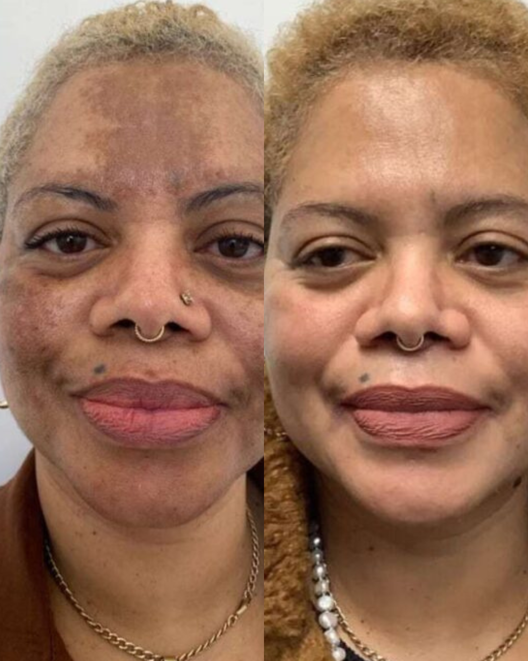 Voor en na resultaat van Dermamelan behandeling tegen melasma in Dordrecht