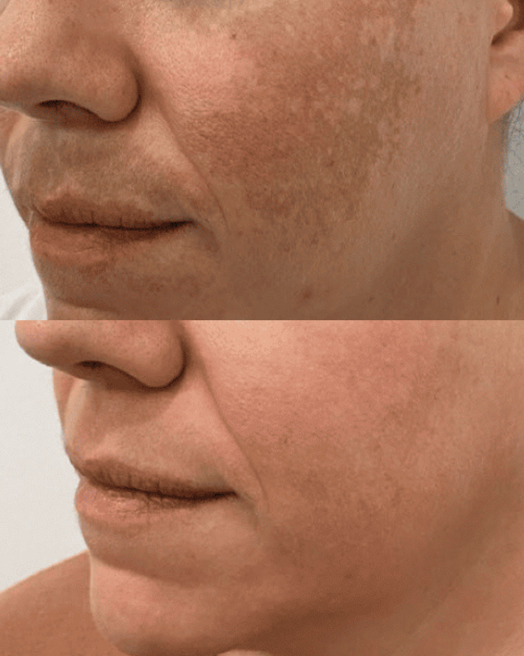 Voor en na resultaat van Dermamelan behandeling tegen melasma in Dordrecht