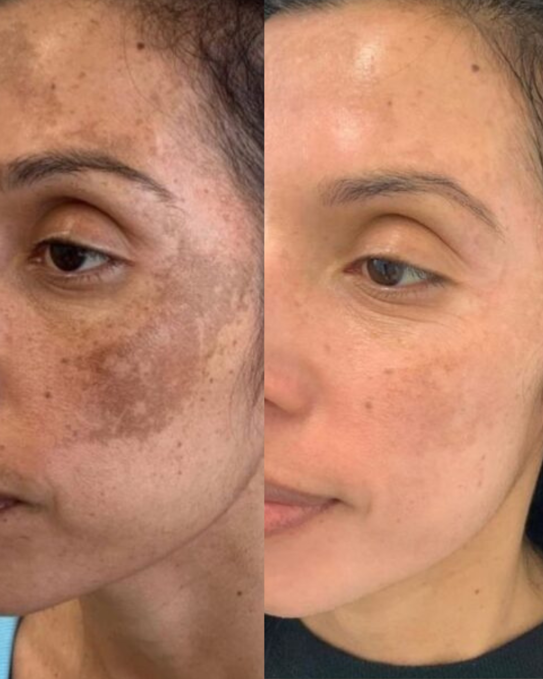 Voor en na resultaat van Dermamelan behandeling tegen melasma in Dordrecht