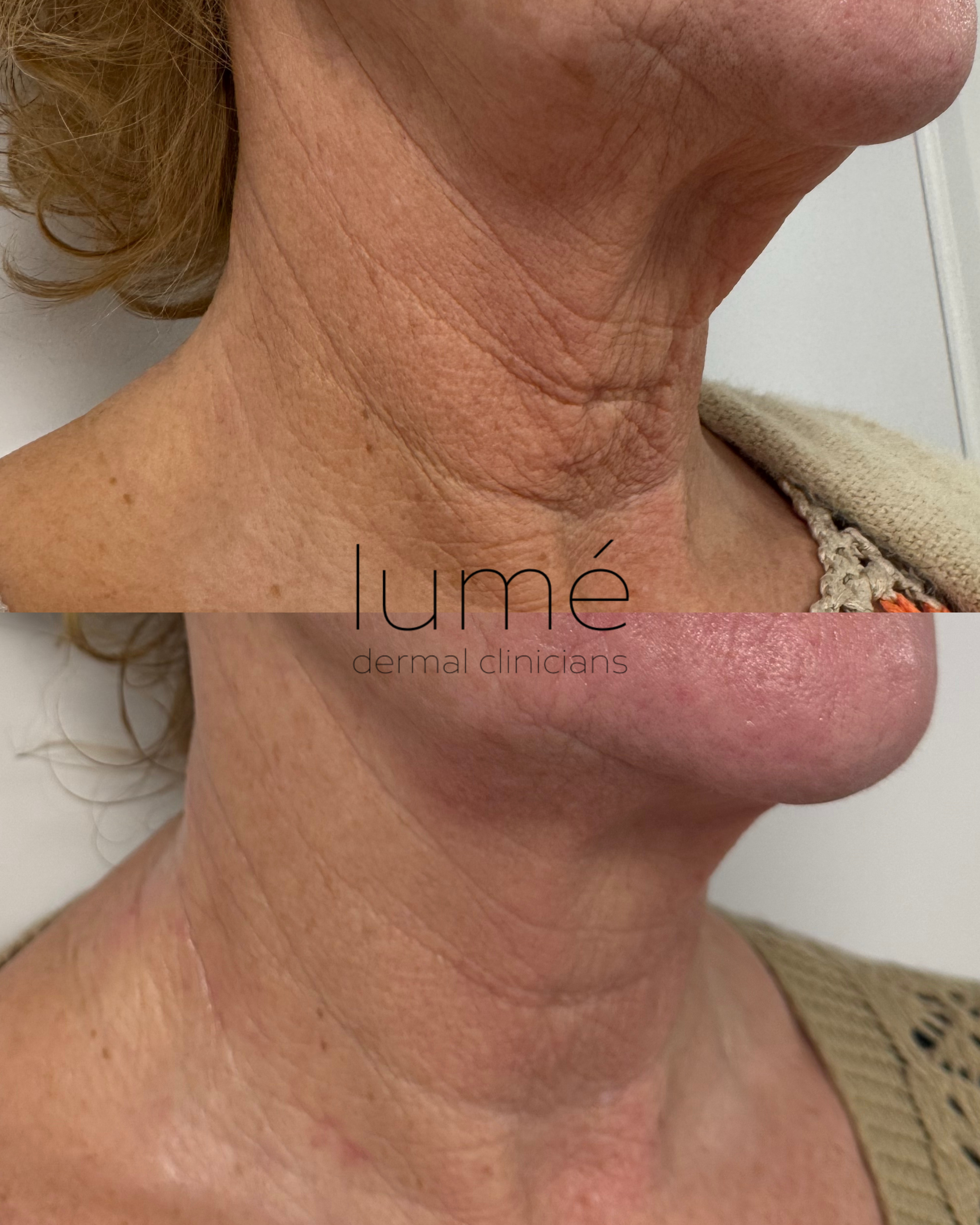 Voor en na resultaat van Morpheus8 behandeling voor huidverstrakking in Dordrecht