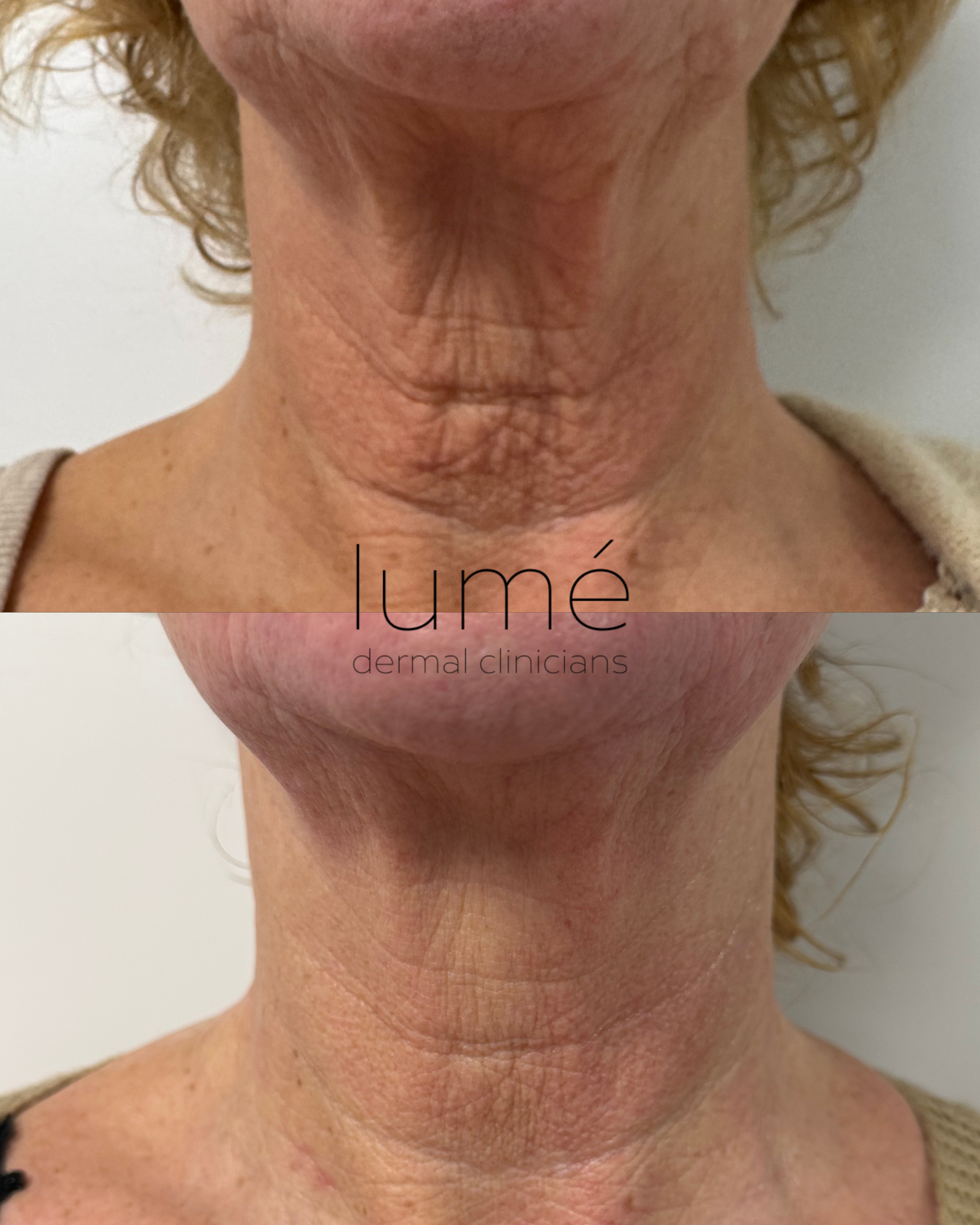 Voor en na resultaat van Morpheus8 behandeling voor huidverstrakking in Dordrecht