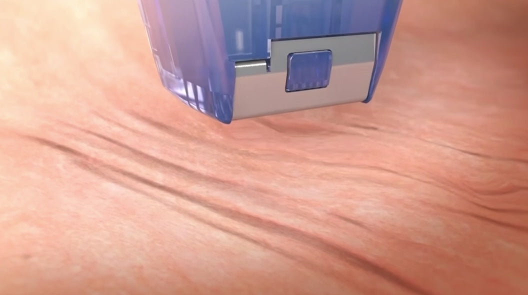 Morpheus8 rf microneedling voor huidverstrakking en acne littekens video