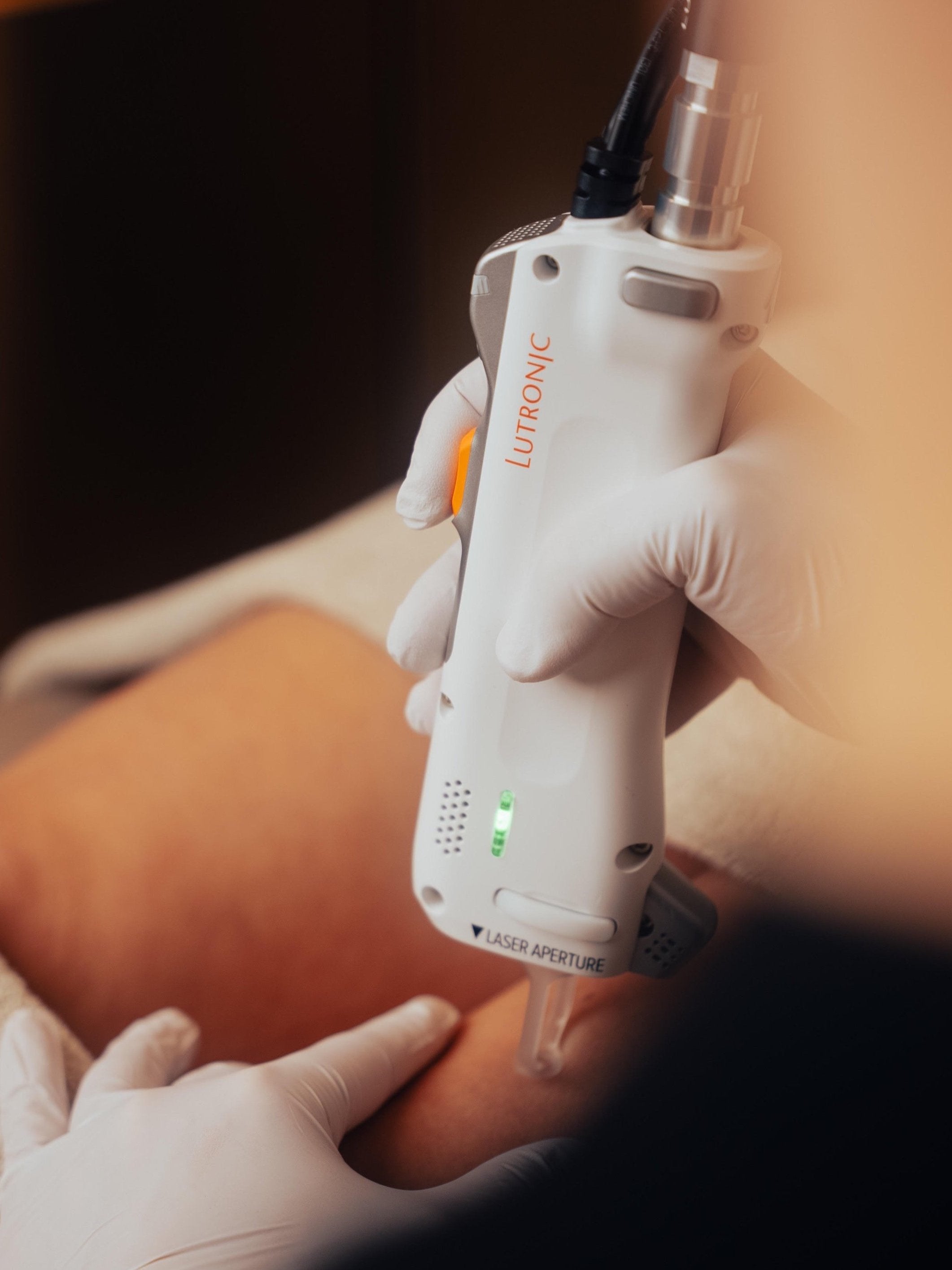 Vaatlaser behandeling voor couperose en zichtbare bloedvaatjes in Dordrecht